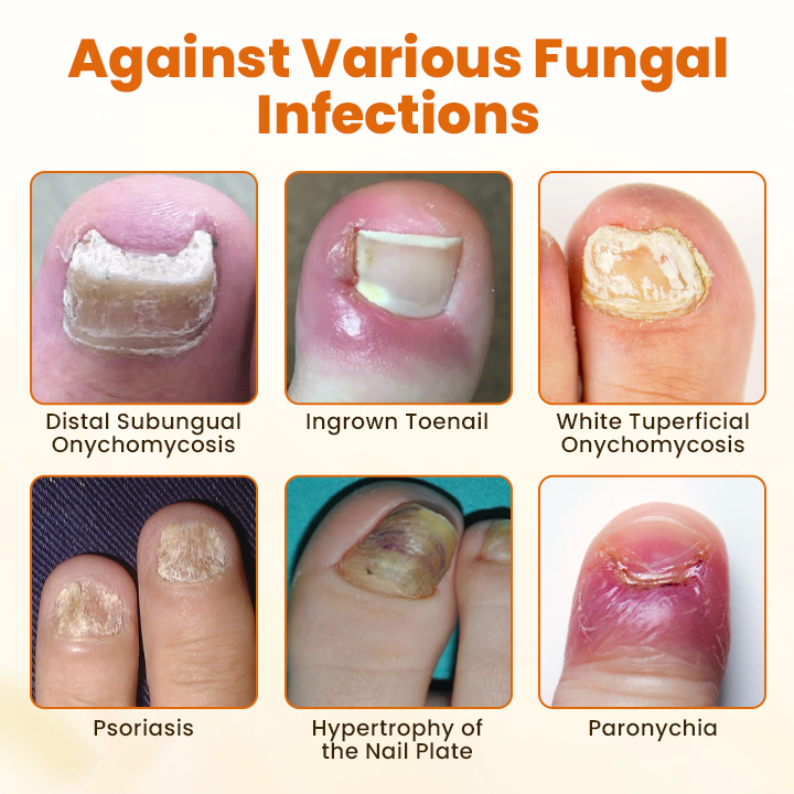 Timilk® FungiBee Fortschrittliches Nagelreparatur-Spray🔥