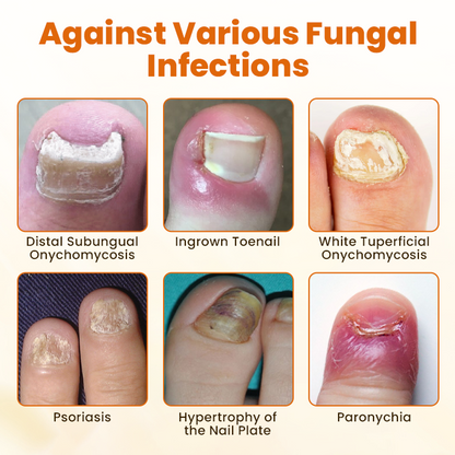 Timilk® FungiBee Fortschrittliches Nagelreparatur-Spray🔥