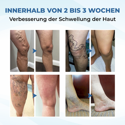 Timilk® TheraVein Kräuter-Spray gegen Krampfadern 🔥