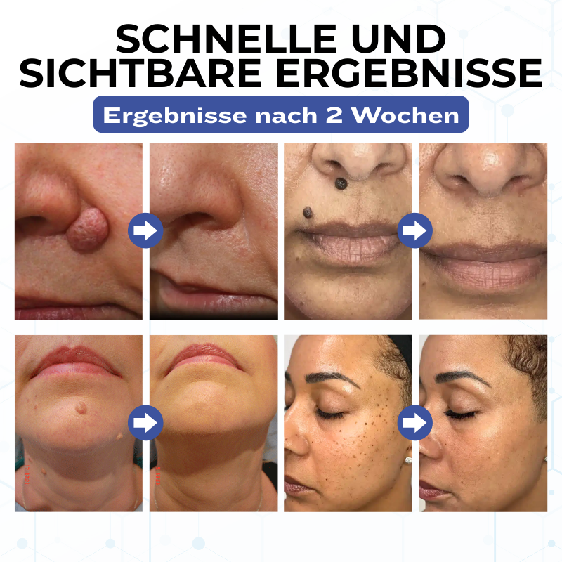 Timilk® VanishPro Hautflecken-Entfernungscreme 🇩🇪