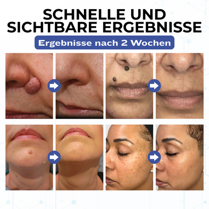 Timilk® VanishPro Hautflecken-Entfernungscreme 🇩🇪