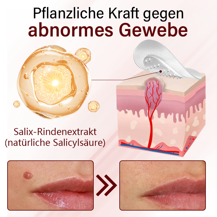 Timilk® Vionara Nano Warzenentfernungs-Pflaster-KeraErase🎁