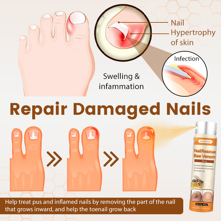 Ceoerty® NailRescue Bienengift-Spray🔥