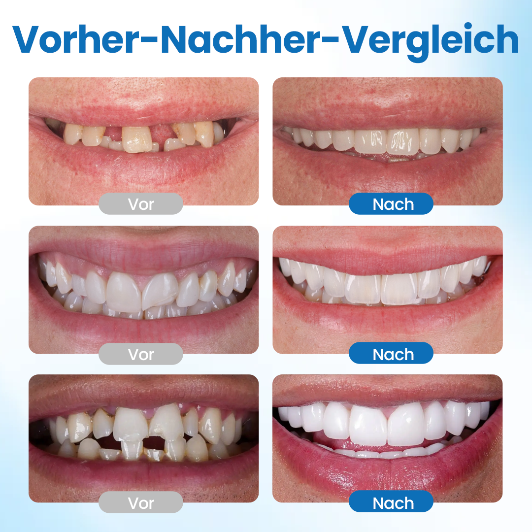 Timilk® SmileMend Zahnreparatur-Füllungsset