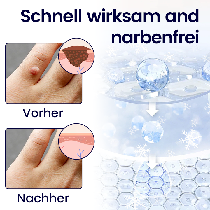 Timilk® WartErase Kryo-Freeze Spray🔥