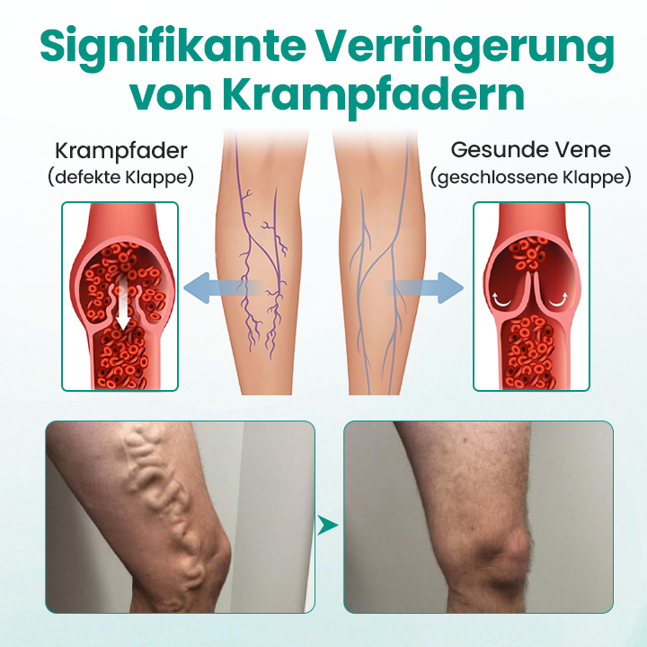 Timilk® LegRenew Krampfaderpflaster
